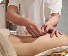 Acupuncture